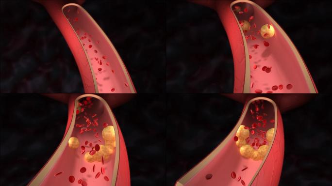 胆固醇阻塞动脉胆固醇阻塞动脉动画医学科普