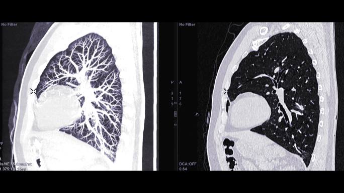 诊断肺栓塞和肺癌。