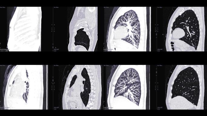 诊断肺栓塞和肺癌。