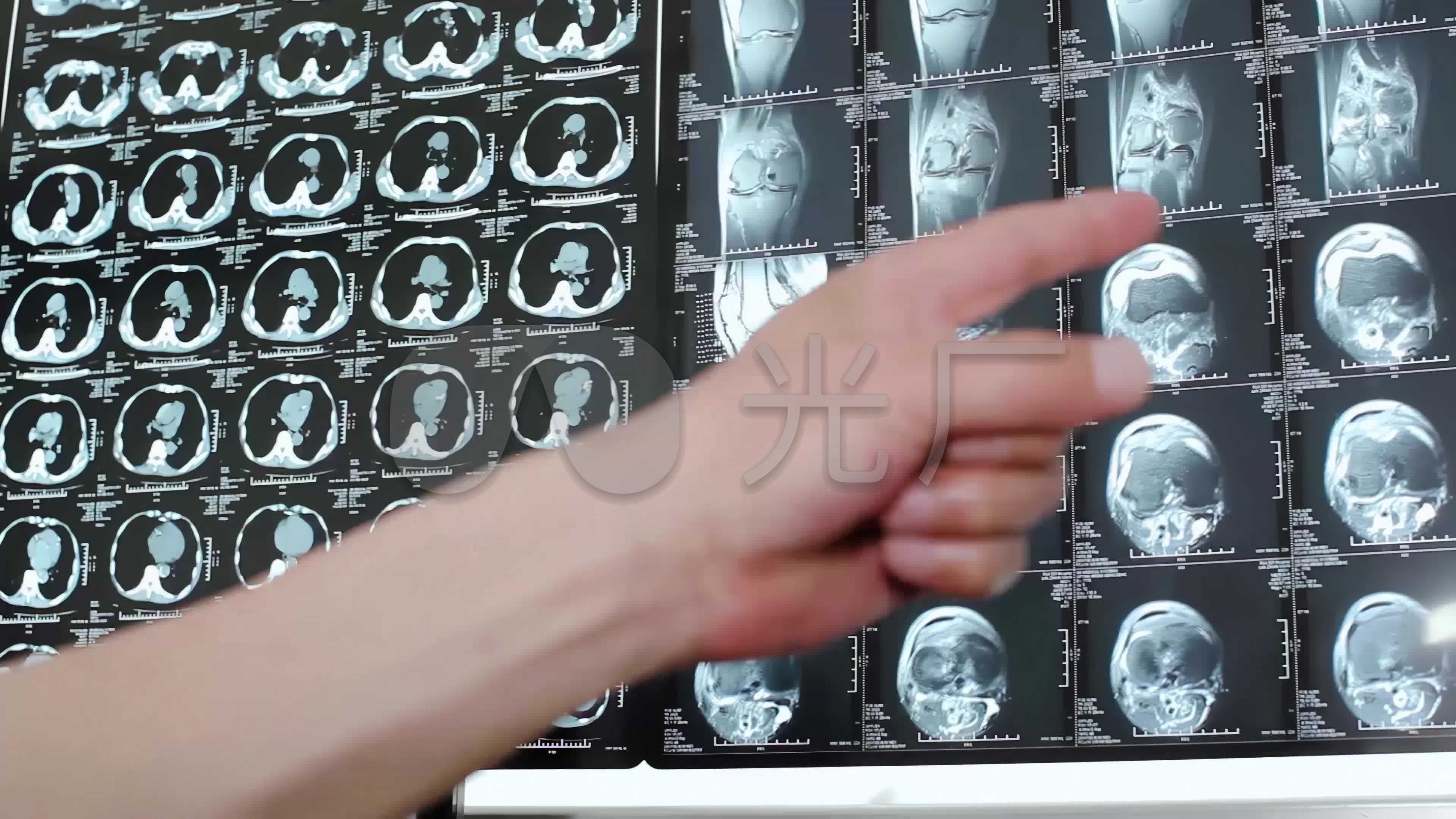 人体肺部、颅脑、内耳、血管、关节部位的CT影像表现|颅脑|肺部|关节|血管|CT|-健康界