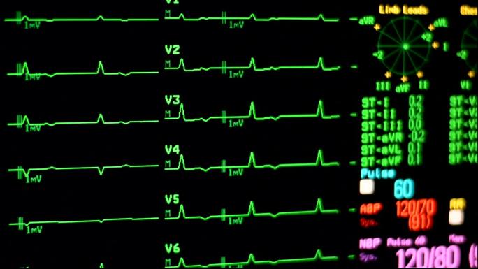心电监护仪