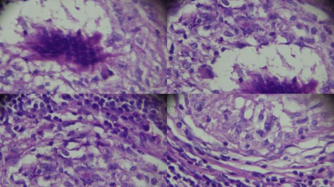 显微镜下淋巴结结核病理标本