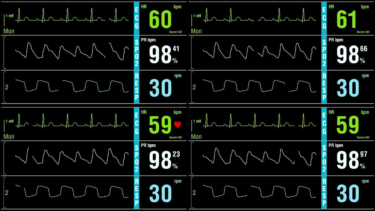 患者监护仪显示体检生命体征