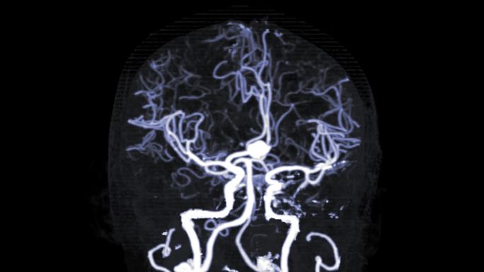 CTA脑或计算机断层扫描脑血管