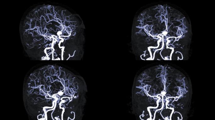 CTA脑或计算机断层扫描脑血管