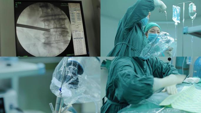 腰间盘椎间孔镜髓核摘除术A
