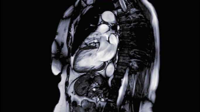心脏核磁共振成像解剖瓣膜医学X射线心跳