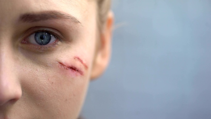 有伤疤的女性受伤毁容伤痕伤口
