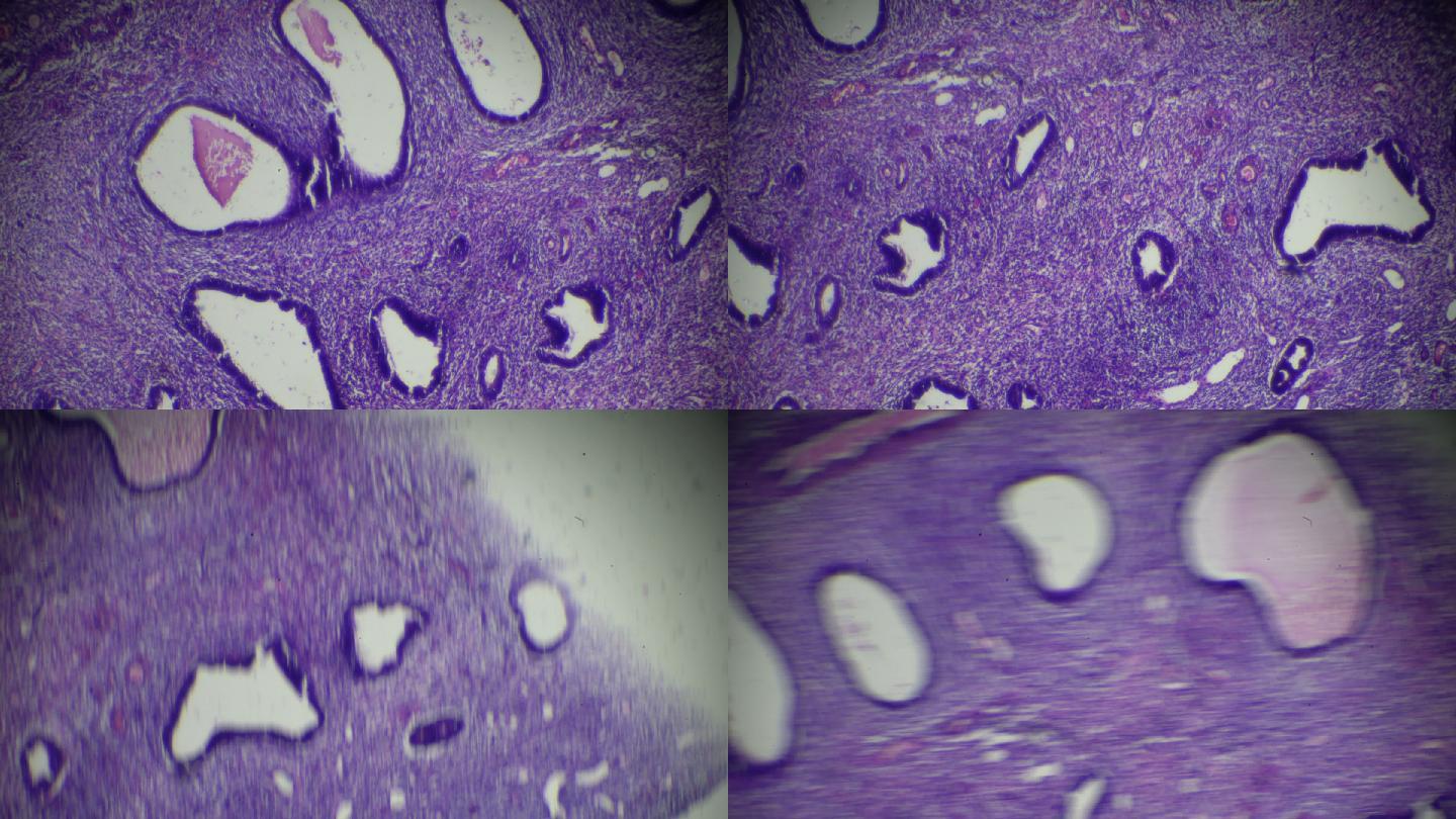显微镜下宫颈息肉可在不同区域放大