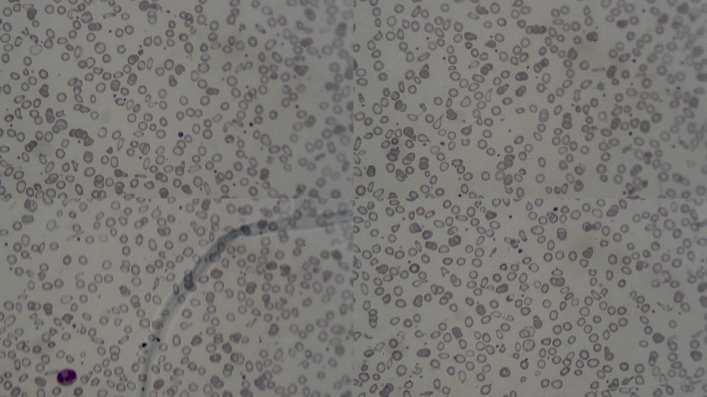 图47 缗钱状红细胞-血液学细胞学-医学