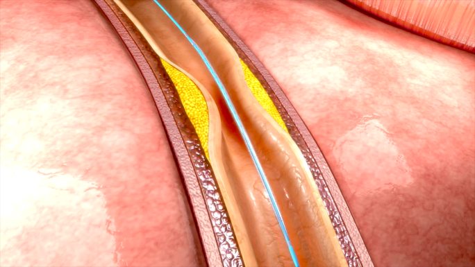 冠状动脉成形术3dcg动画血栓微创血管栓