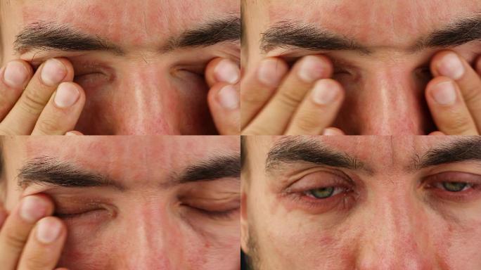 男性眨眼和抓伤眼睛出现过敏反应