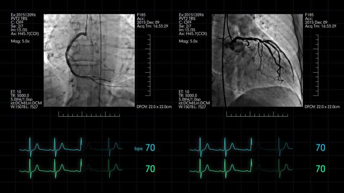带心率监测显示的灰色心血管造影
