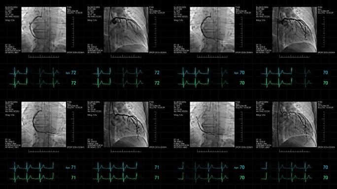 带心率监测显示的灰色心血管造影
