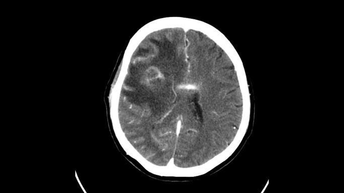 脑部CT医生医学设备ct检查护士医疗手术