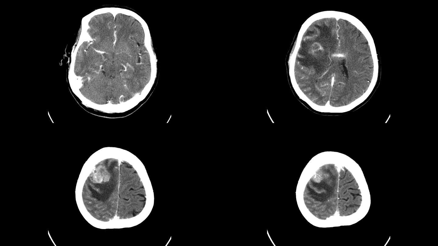 脑部CT医生医学设备ct检查护士医疗手术