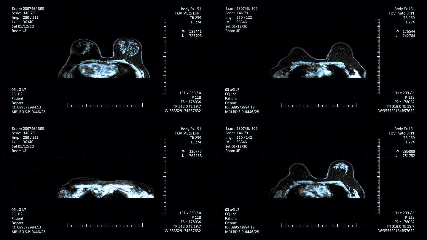 乳腺常见病变的MRI表现 - 乳腺肿瘤学 - 天山医学院