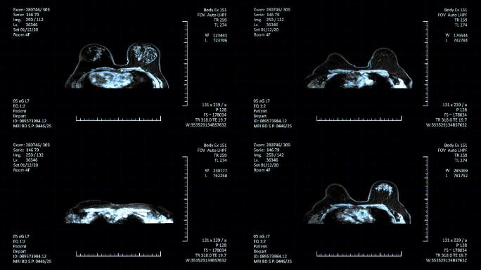 乳腺癌诊断磁共振扫描
