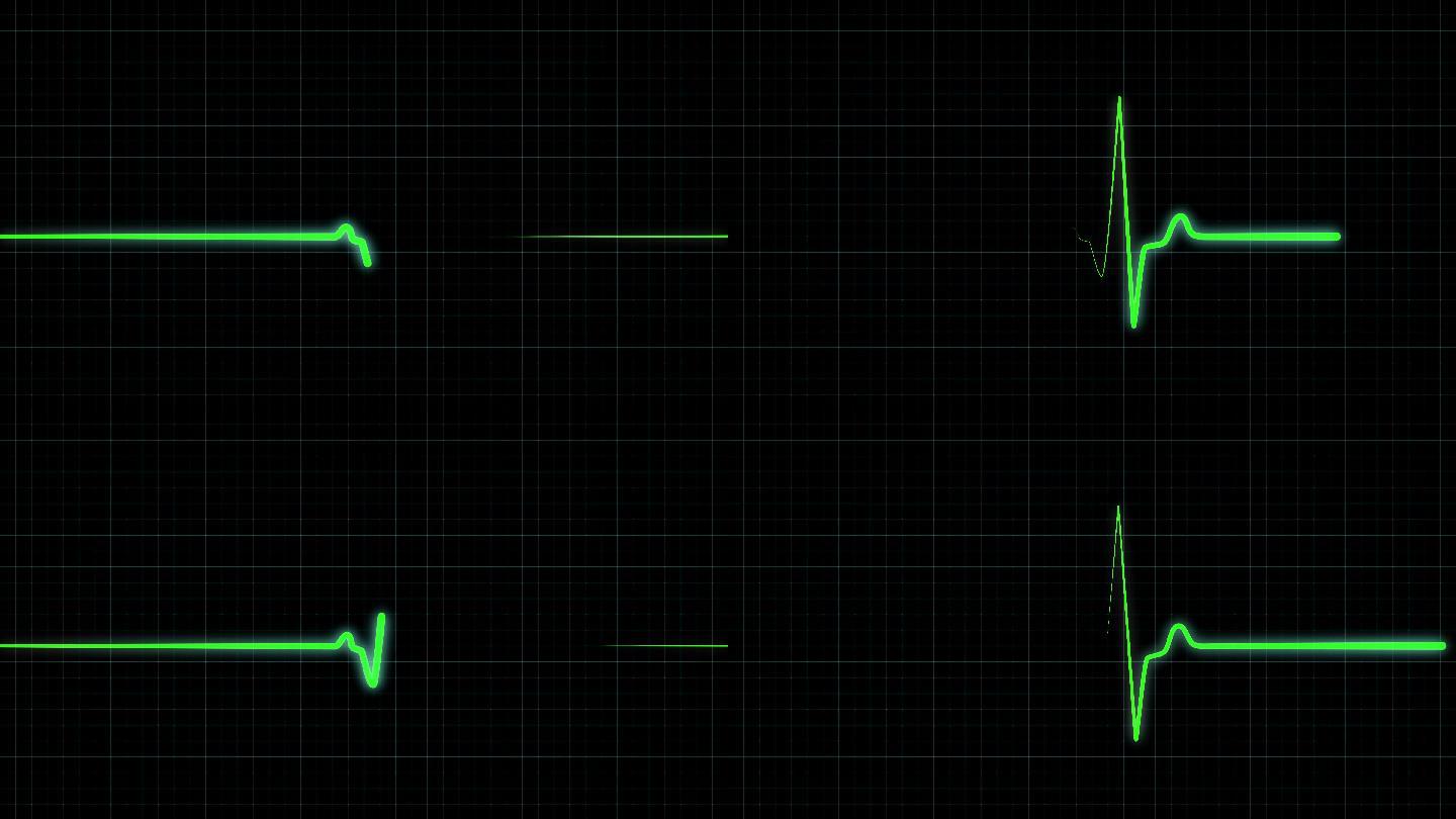 医学屏幕上的绿色心律图
