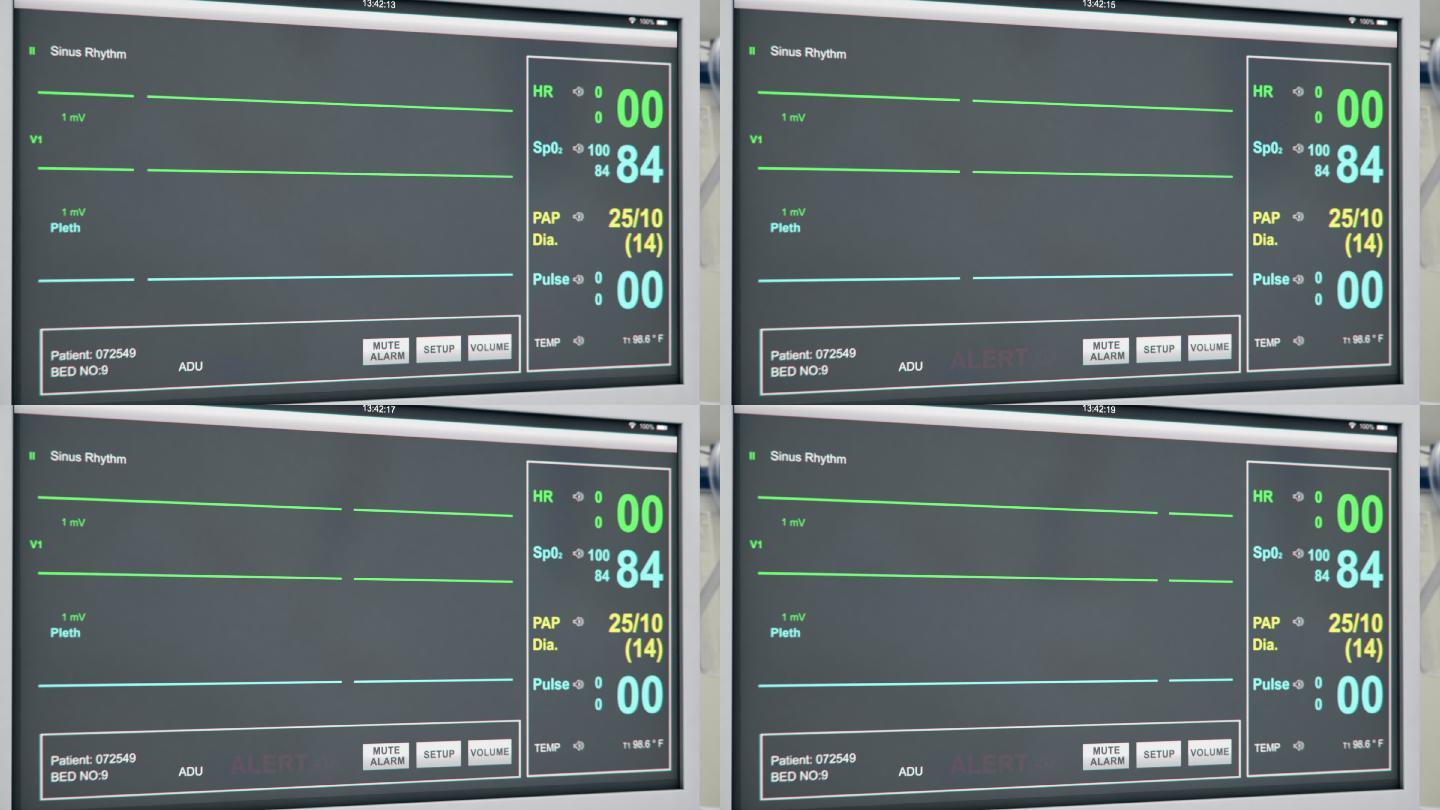 EKG患者心脏监护仪屏幕视图