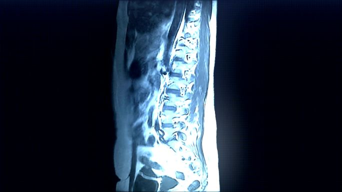 脊柱MRI扫描医学X射线人体脊柱