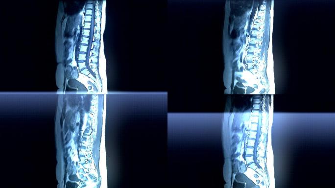 脊柱MRI扫描医学X射线人体脊柱