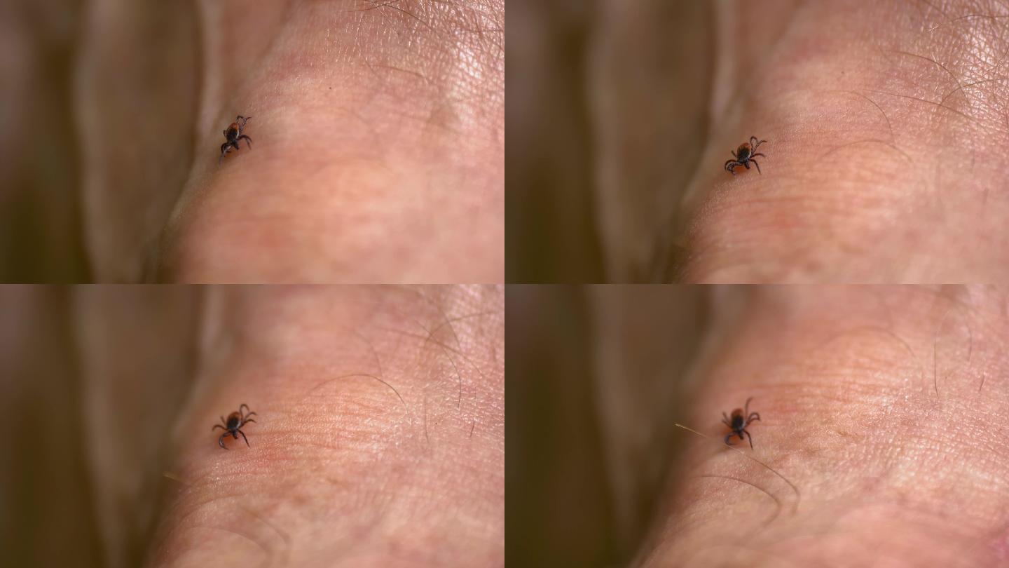 蜱在人类皮肤上行走