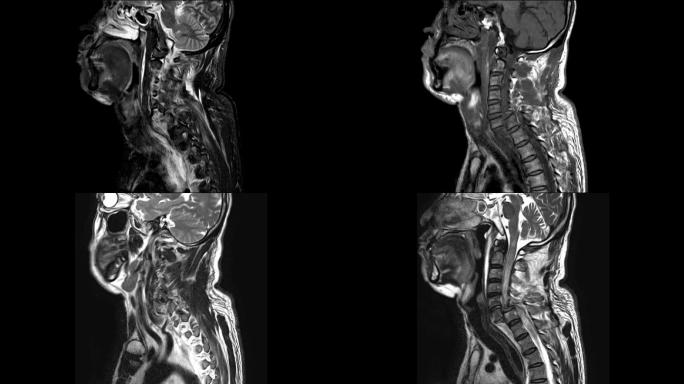 一个有颈椎MRI病史的X影片