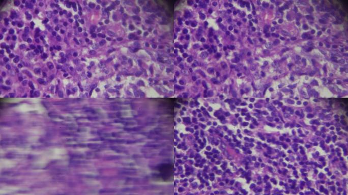 显微镜下淋巴结结核病理标本