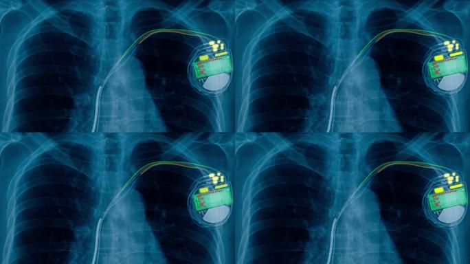 心脏起搏器细胞的x射线胶片