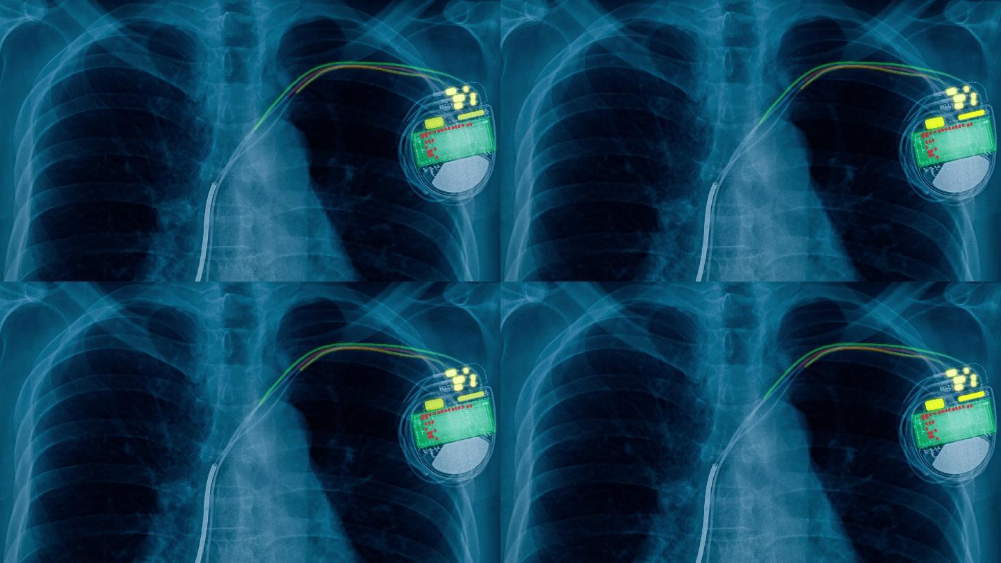 心脏起搏器细胞的x射线胶片