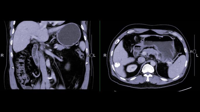 CT上腹部冠状位和轴位对比图。