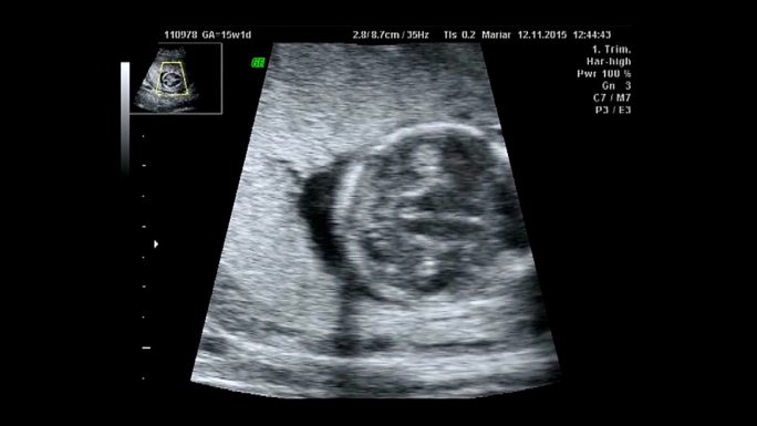 婴儿脑部扫描心跳胎儿