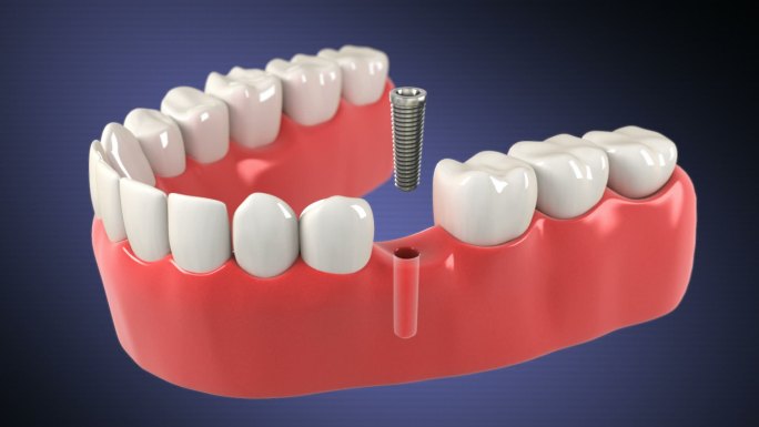 种植体的安装过程口腔医疗种植牙镶牙