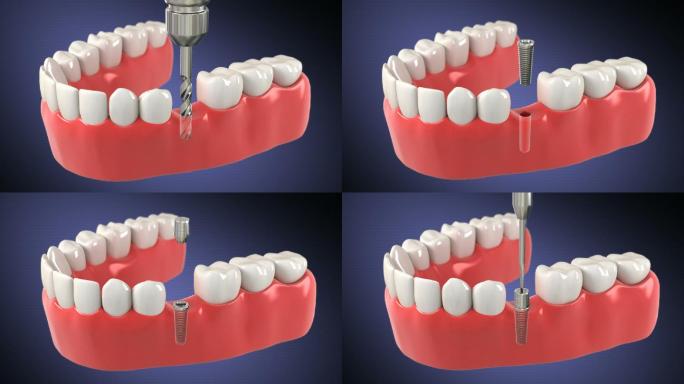 种植体的安装过程口腔医疗种植牙镶牙