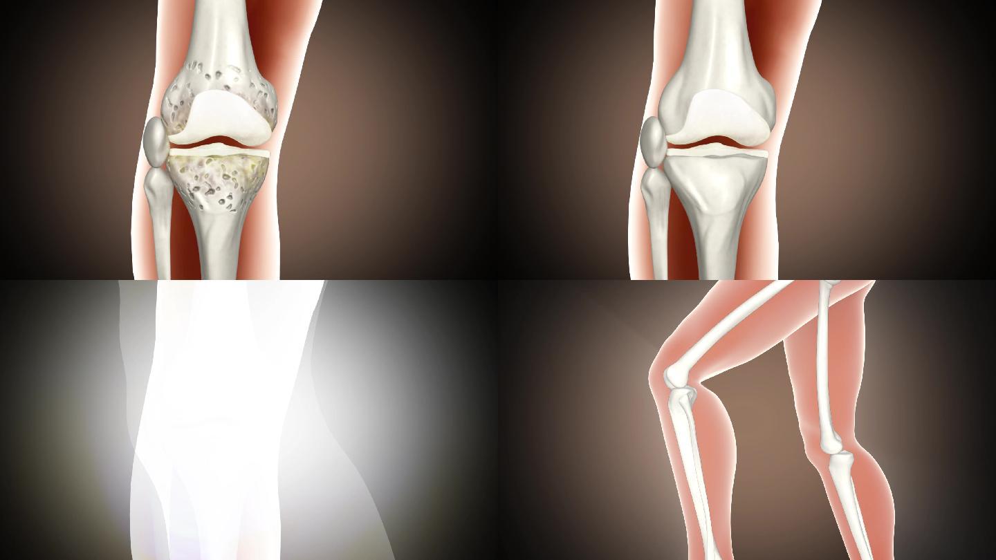 修复 关节 关节炎 软骨 软组织