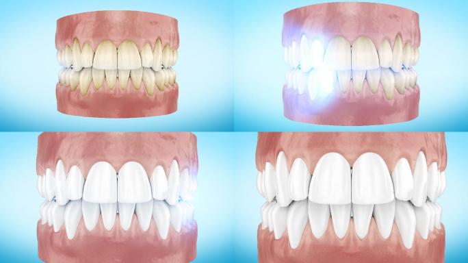 牙齿美白程序近距离3d动画