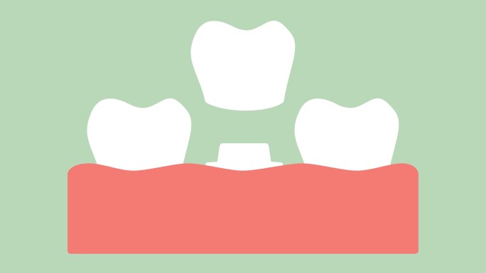 安装牙齿过程的动画