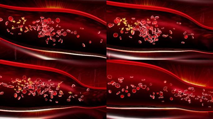 血管内凝聚成团的血红细胞血栓溶解