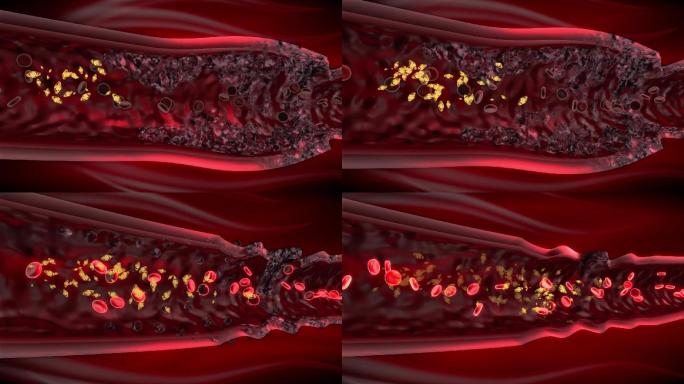 血管内粘着的斑块血栓开始软化溶解恢复弹性