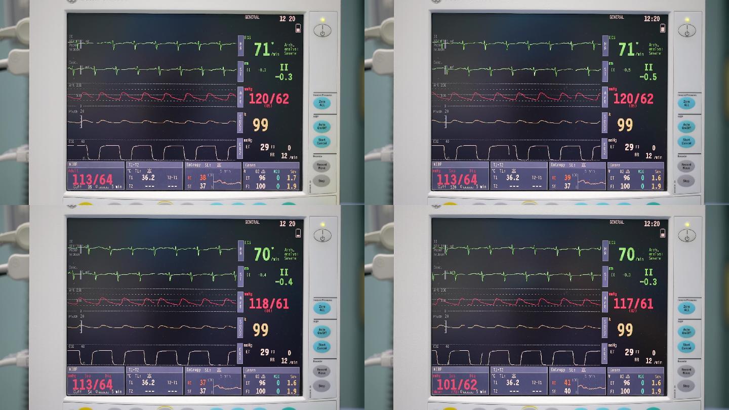 医院标准心电监护仪素材实拍