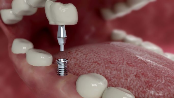 牙科植入物安装正畸医生牙齿三维