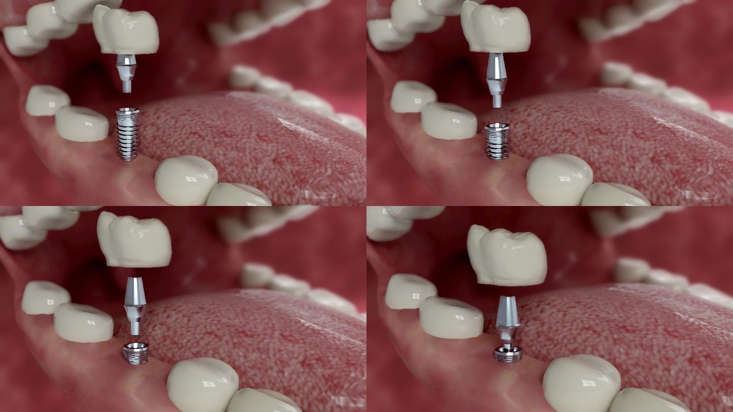 牙科植入物安装正畸医生牙齿三维