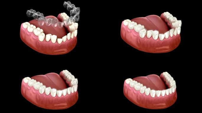 隐形牙套或隐形固位器进行咬合矫正。医学上精确的3D动画