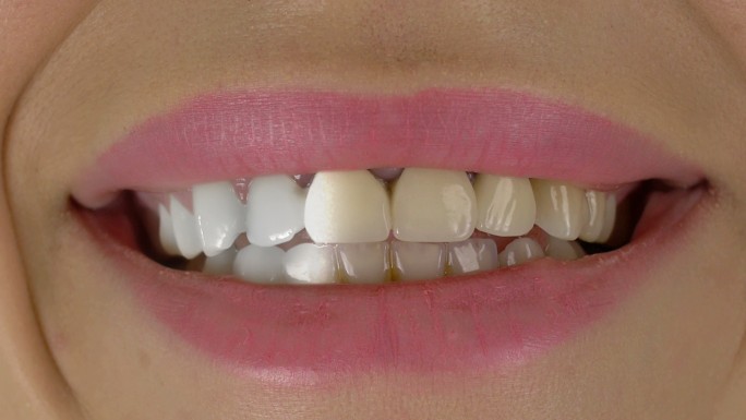 牙齿美白口腔防蛀美白牙医牙齿防护坚固健康