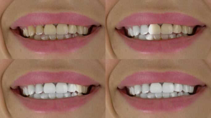 牙齿美白口腔防蛀美白牙医牙齿防护坚固健康