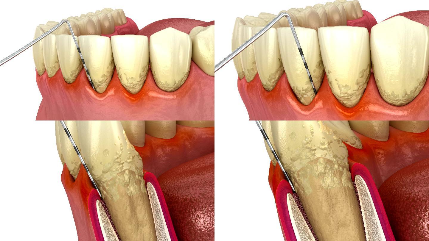 牙周炎测试口腔问题模拟