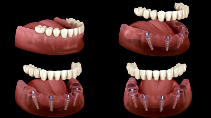 下颌骨假体全部在4个系统上，由种植体支撑
