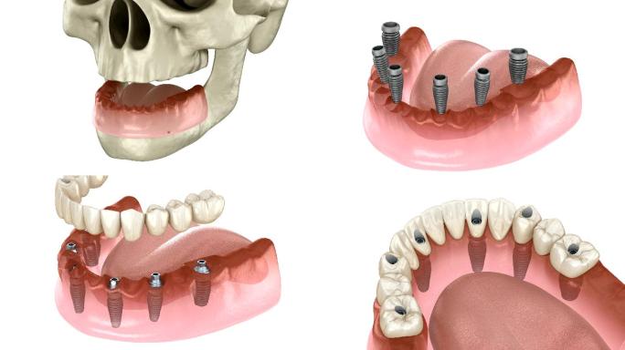 牙科概念的医学精确3D动画