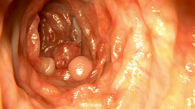 肠息肉肠镜微创手术恶性